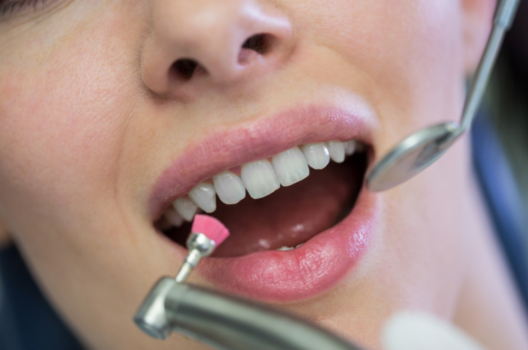Teeth Cleaning (Scaling & Polishing)
